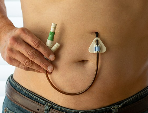 PEG Feeding Training Level 3